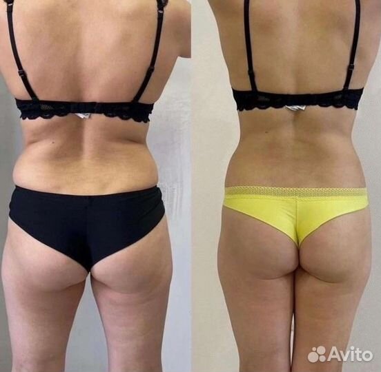 LPG массаж, Классический, Кавитация,smas-лифтинг