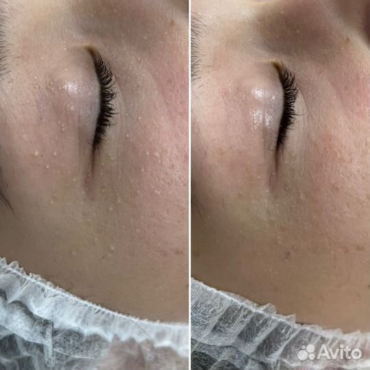 Милиум/Белые угри/Чистка