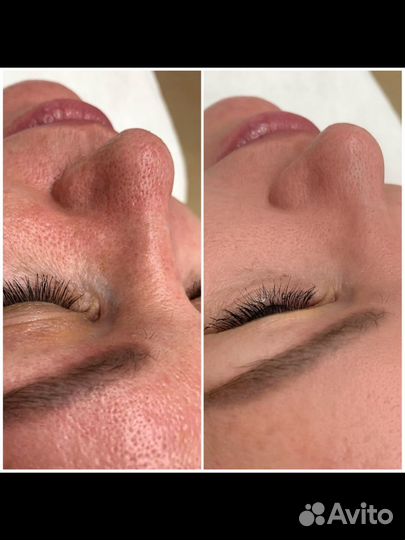 Косметология увеличение губ мезонити