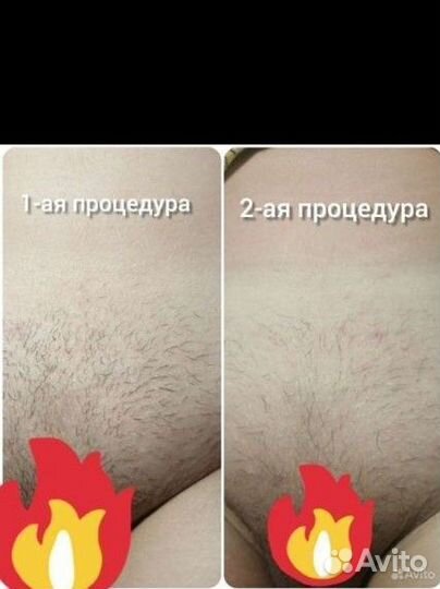 Электроэпиляция