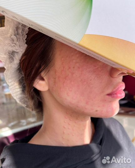 Коктейль монако мезотерапия биоревит липолитики