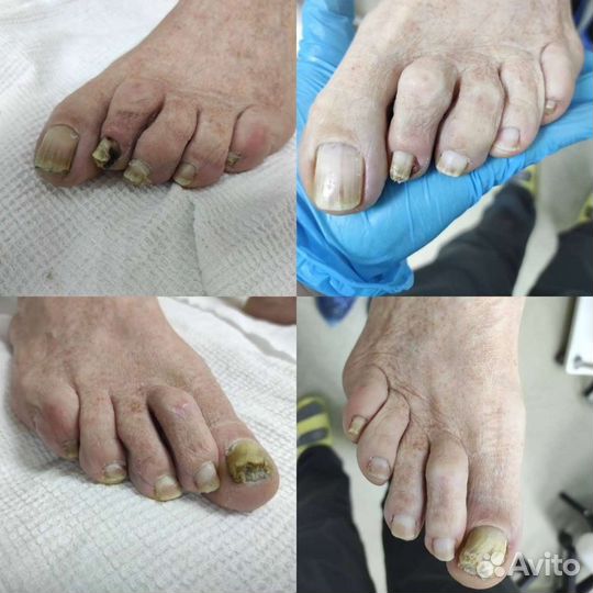 Медицинский педикюр подолог
