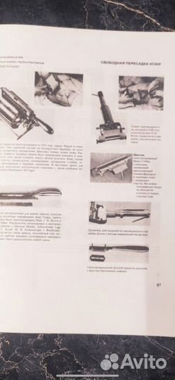 Пересадка кожи