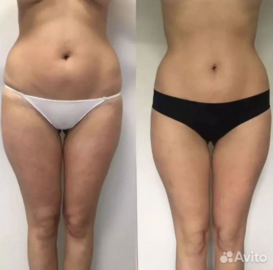 Коррекция фигуры: LPG массаж