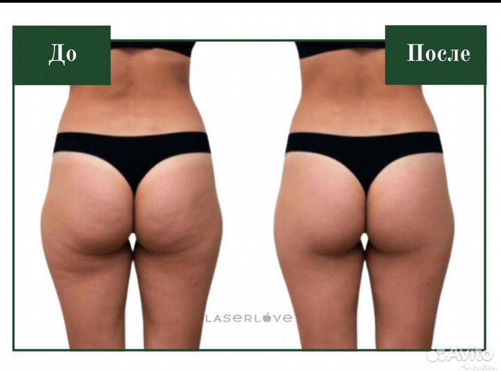 Аппаратный LPG массаж