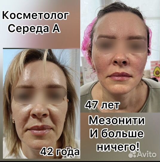 Мезонити Коги люкс