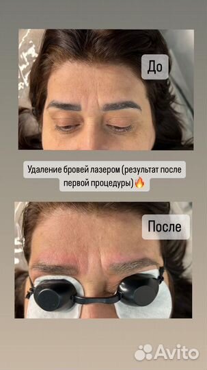 Удаление татуажа,тату лазером,ремувером