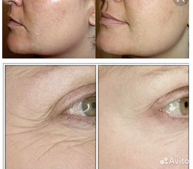 Rf лифтинг лица