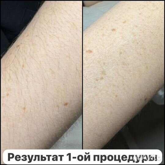 Электроэпиляция Apilus