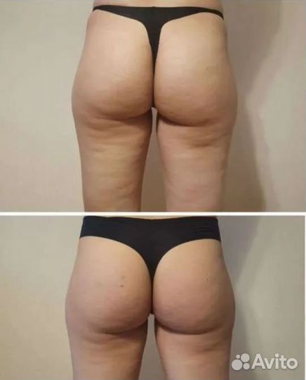 Коррекция фигуры: LPG массаж