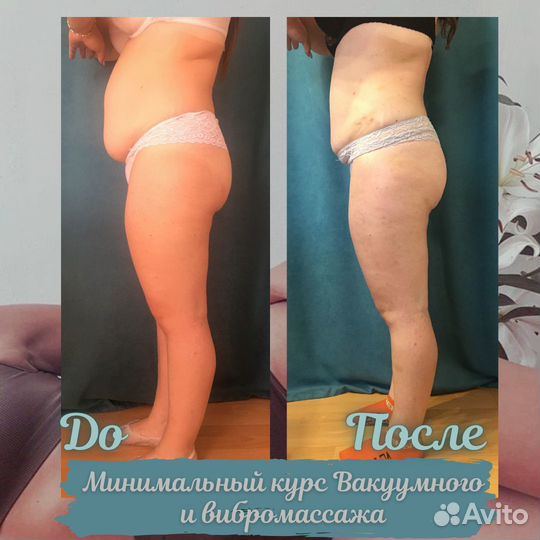 Вакуумный массаж