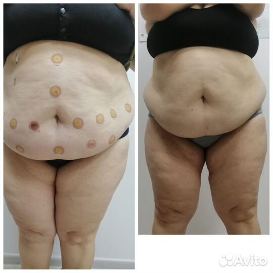 Массаж по уменьшению объёмов тела