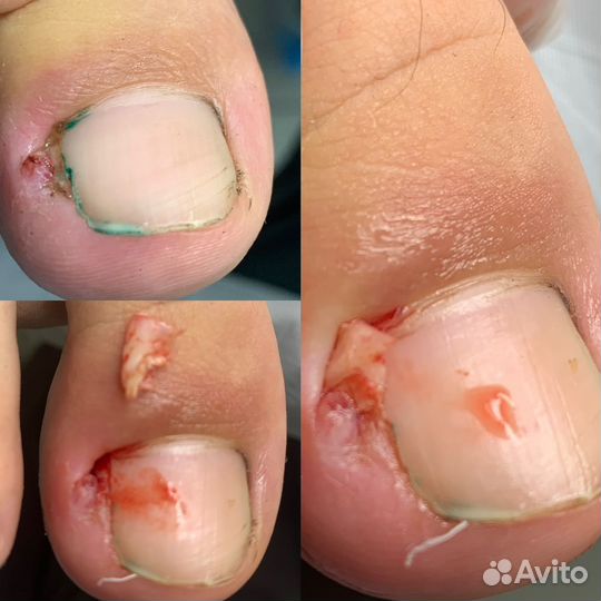Педикюр, подолог, вросший ноготь