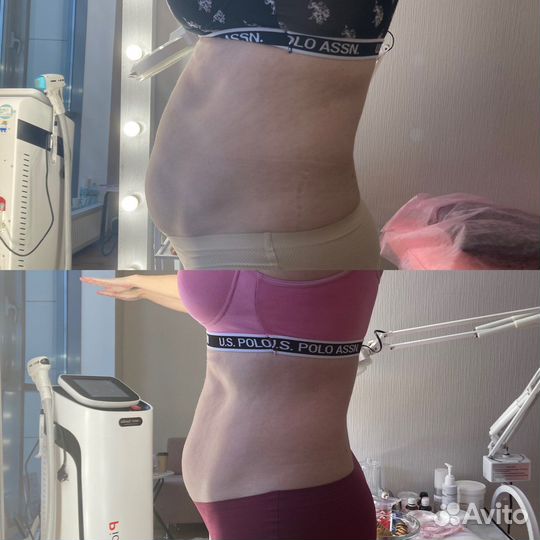 Антицеллюлитный массаж,коррекция фигуры