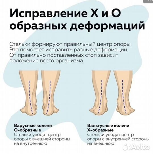 Изготовления ортопедических индивидуальгых стелек