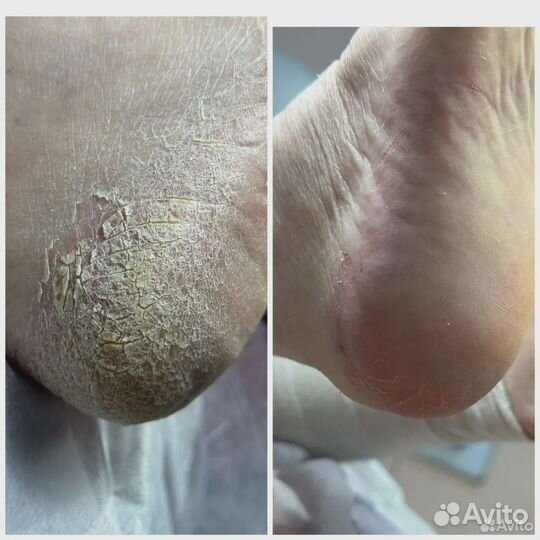 Подолог, педикюр