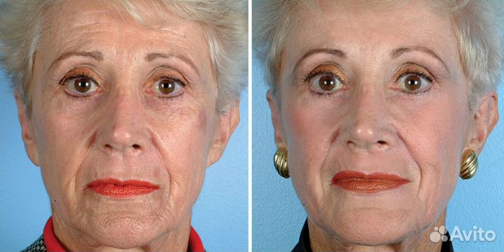 Модели на Алмазный Пилинг (бесплатно)