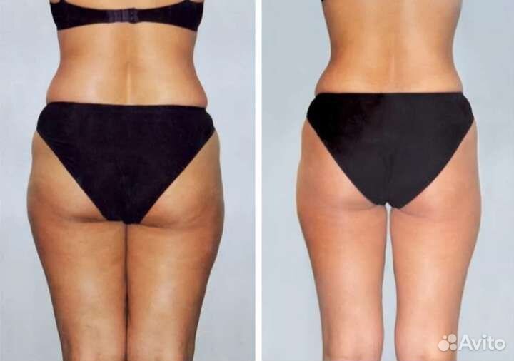 Массаж.Лпдж массаж.вибромассаж.Лпдж массаж лица