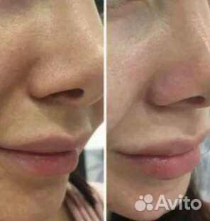 Ультразвуковой аппарат для чистки лица новый