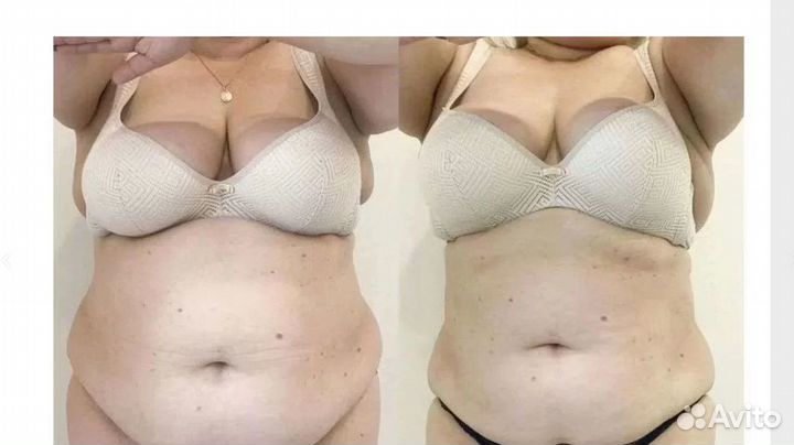 Похудение для мужчин и женщин Криолиполиз Кирове