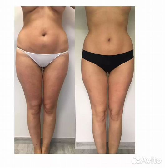 LPG массаж, антицеллюлитный