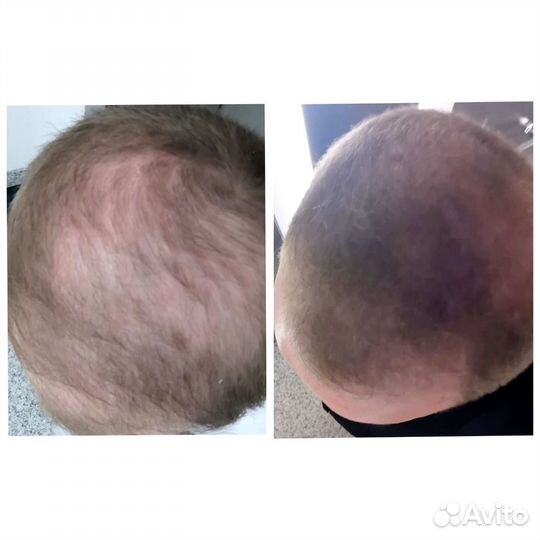 Лечения выпадения волос у мужчин