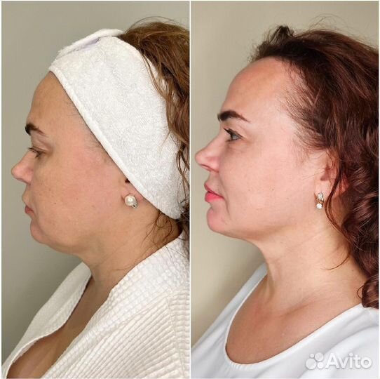 Микроигольчатый RF лифтинг