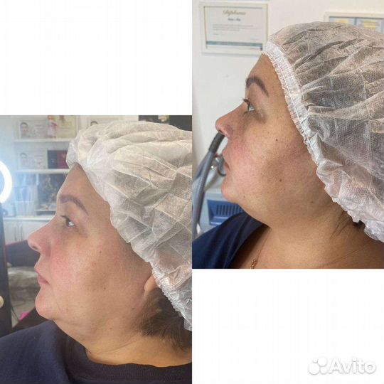 Карбокситерапия (газовые уколы)