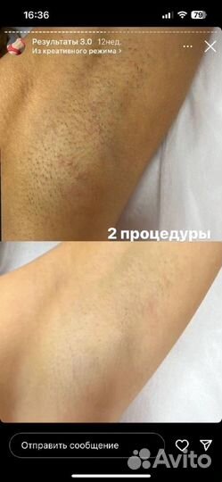 Лазерная эпиляция