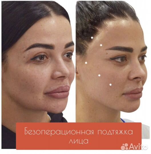 Смас лифтинг