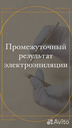 Электроэпиляция