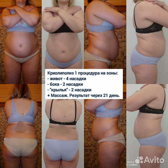 Криолиполиз Массаж Кавитация (коррекция фигуры)