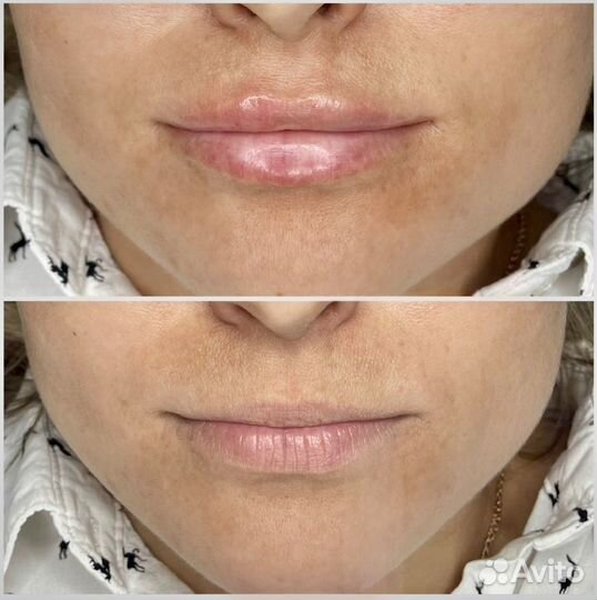 Коррекция губ, увеличение губ