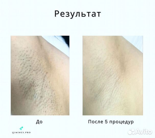 Диодный лазер Lumines’ MaxPlus 2000