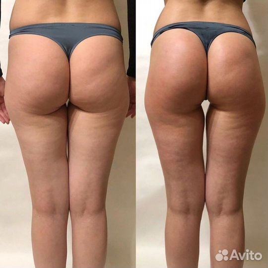 Кавитация#, RF Лифтинг, LPG, Горячий вакуум