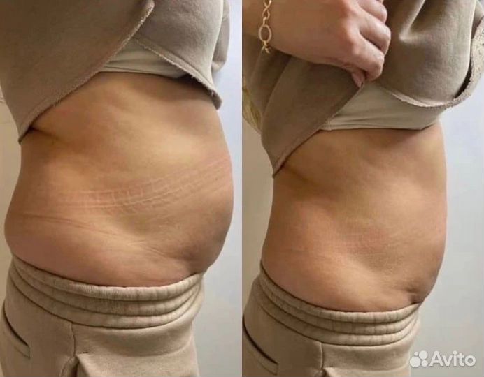 Криолиполиз