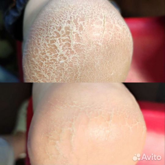 Медицинский педикюр подолог