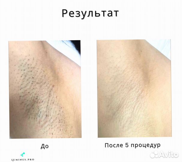 Диодный лазер для эпиляции Lumines’ Макс’Плюс 2000в