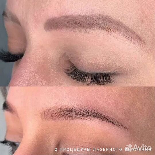 Удаление татуажа лазером, ремувером