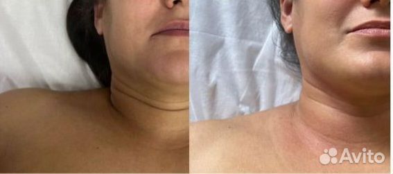 Массаж лица