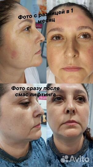 Косметолог. SMAS лифтинг