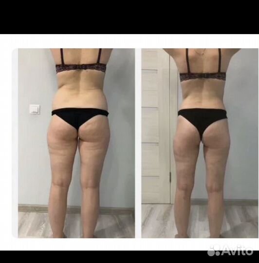 Общий массаж + LPG массаж в Девяткино