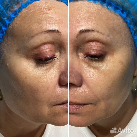 Lpg массаж/вибромассаж G5/кавитация/липолиз/рф