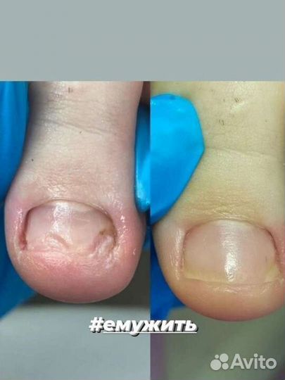 Услуги подолога с выездом на дом