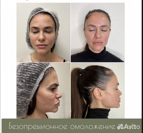 Смас лифтинг