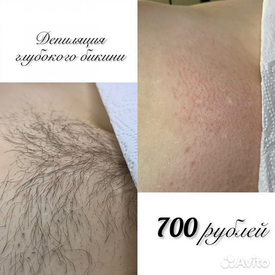 Депиляция воском: бёдра