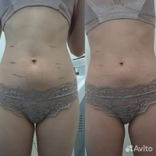 Роликовый массаж (бьютилазер)