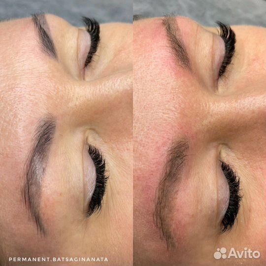 Удаление татуажа