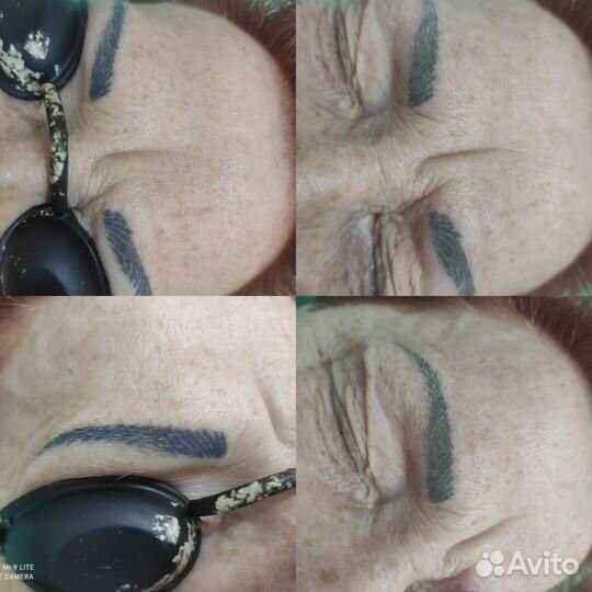 Лазерное удаление тату, перманента