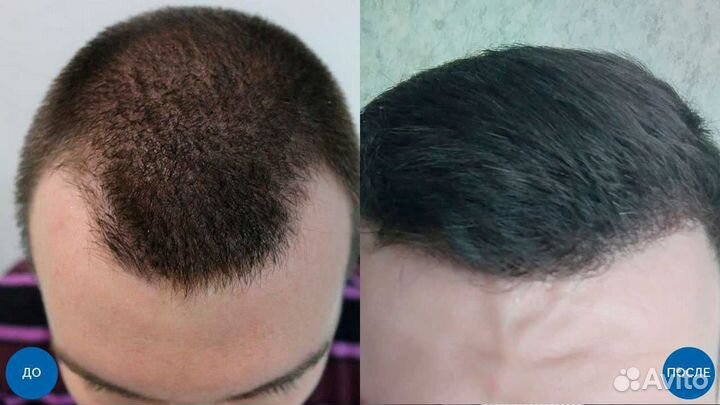 Пересадка волос методом FUE